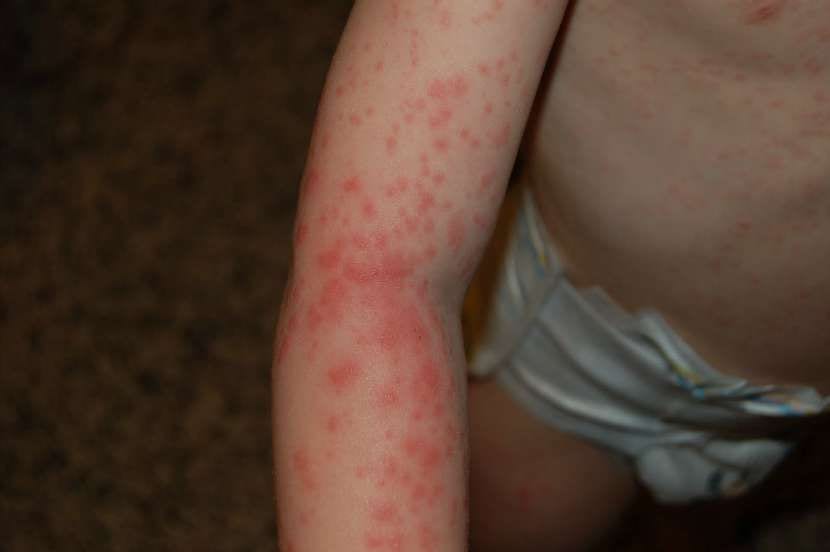 Escarlatina ve Fiebre Escarlata: Nasıl Bulaşır, Belirtileri, Tedavisi ve Önlemleri