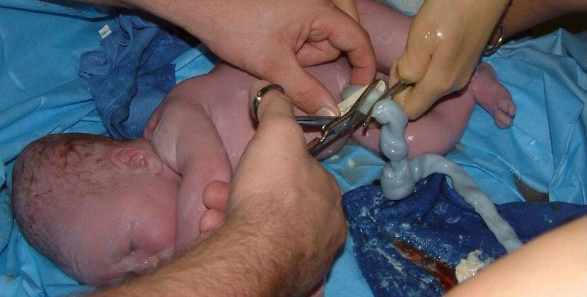 Göbek Kordonu Prolapsusu: Nedir, Nedenleri, Riskleri ve Doğum Sırasındaki Çözümleri